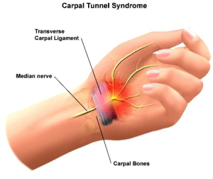 Carpal Tunnel Syndrome - Vale Health Clinic in Tunbridge Wells