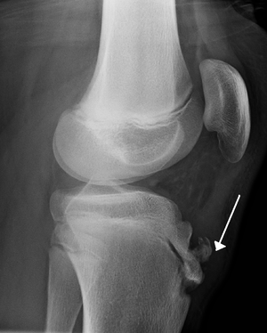 Radiograph_of_human_knee_with_Osgood–Schlatter_disease