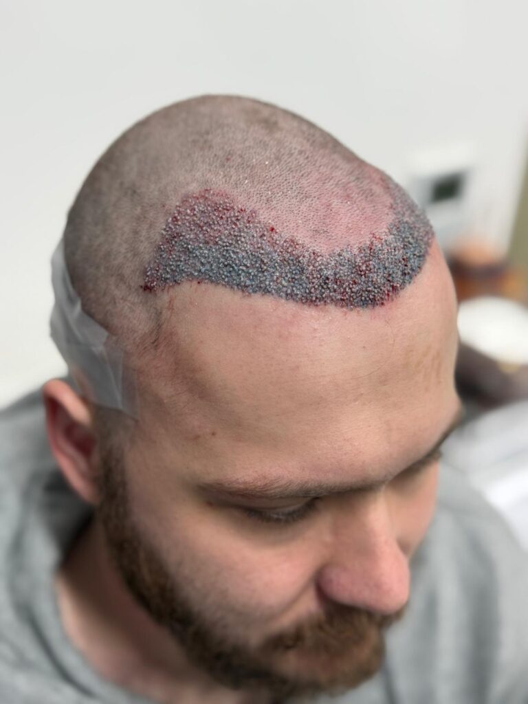 Detailed view of the recipient area following a hair transplant, showcasing the integration of new follicles along the temple and hairline.