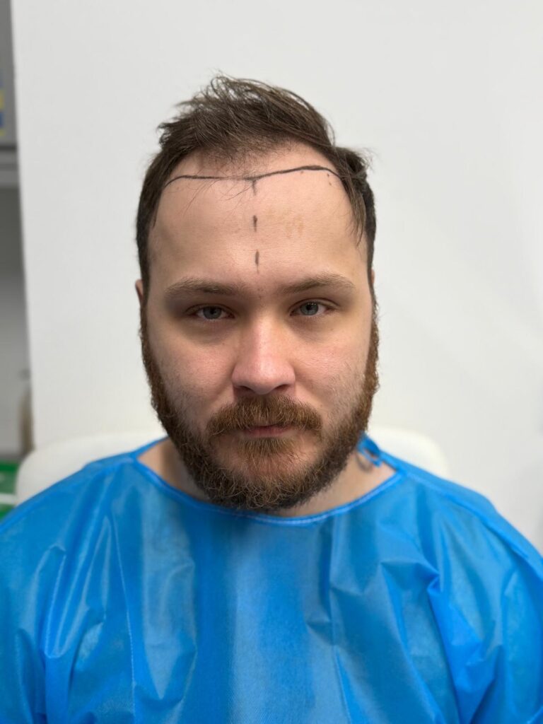 Frontal view of surgical scalp mapping; a custom-designed hairline drawn to match the patient's facial proportions for a natural hair transplant result.