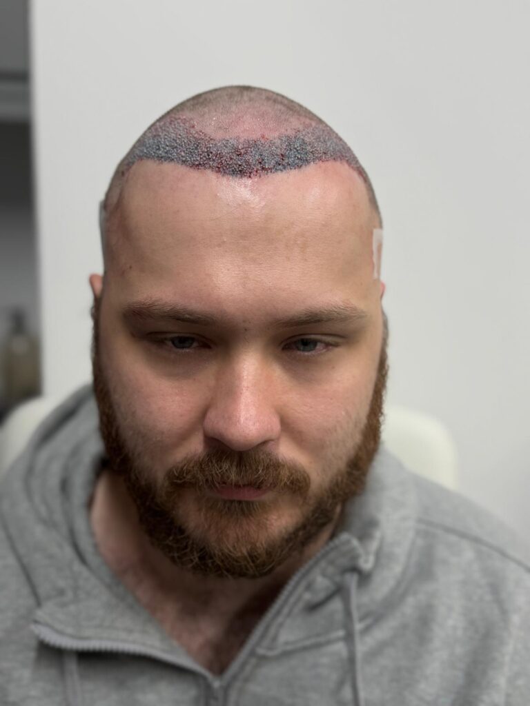 Immediate post-operative frontal view of a hair transplant patient; demonstrating the restored hairline shape and density.