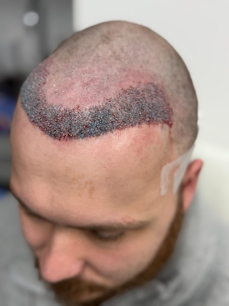 Close-up of high-density FUE hair transplant grafts immediately after placement, showing the precise staggered pattern for a seamless hairline.