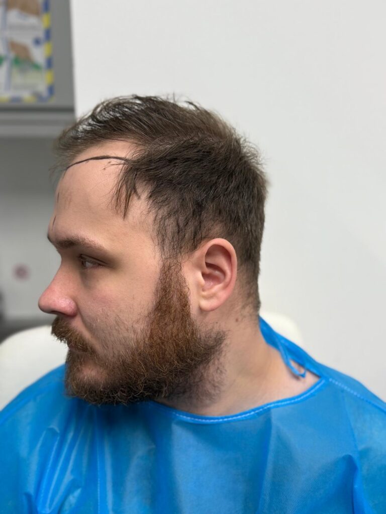 Left profile view of a male patient showing surgical hairline markings for a natural temple reconstruction at Vale Health Clinic.