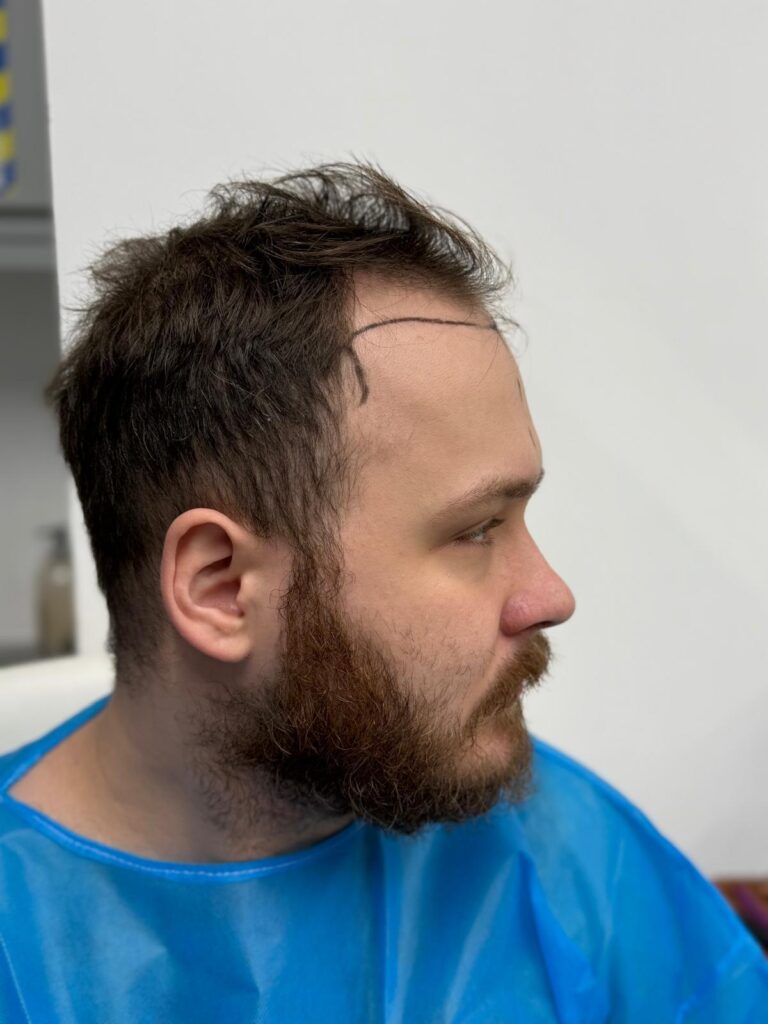 Right profile view showing clinical markings for hair graft placement, designed to mimic natural hair growth patterns.