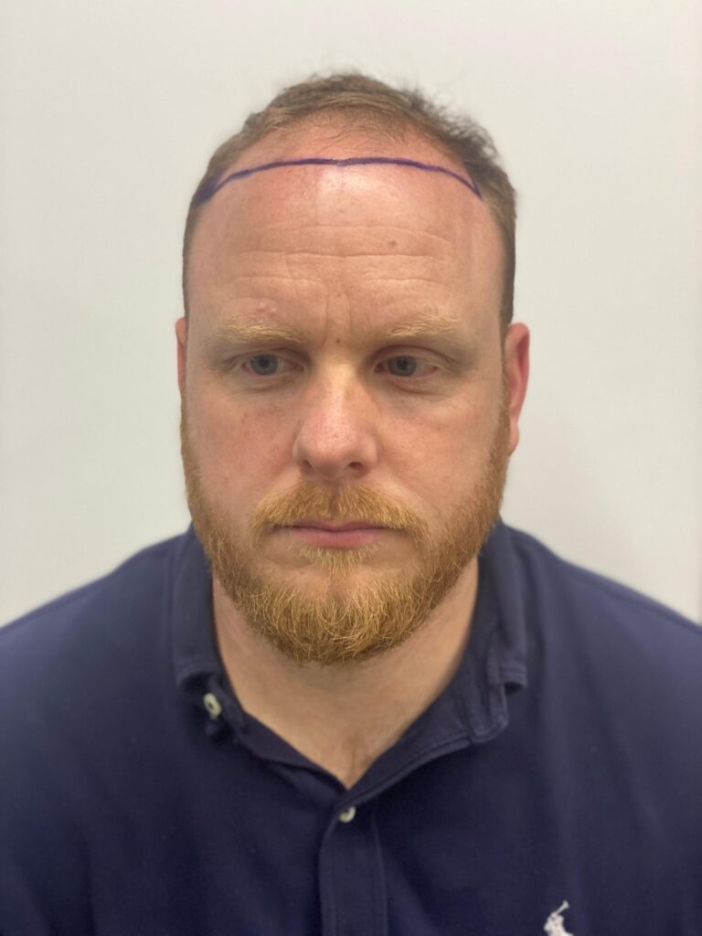 Front view of male pattern hair loss with surgical markings for hairline redesign and density improvement