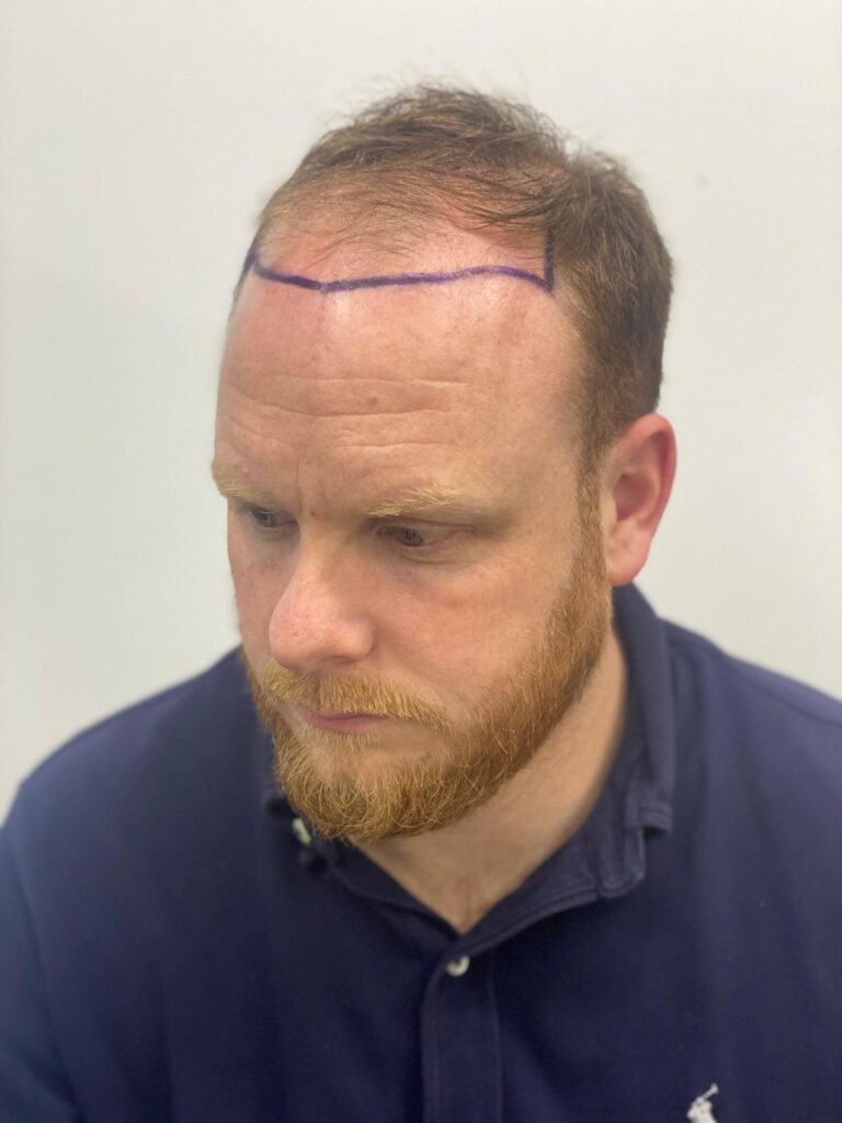 Side profile of a male patient with a marked hairline for a corrective hair transplant at Vale Health Clinic