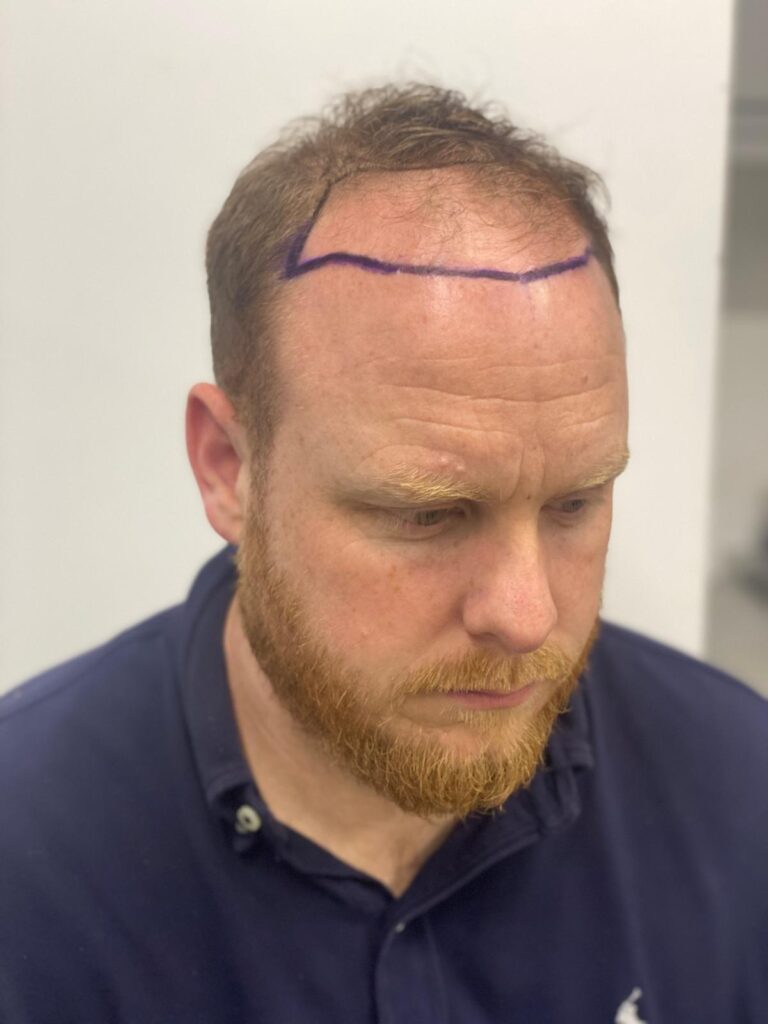 hree-quarter view showing thinning temples and planned hair restoration areas before a corrective procedure