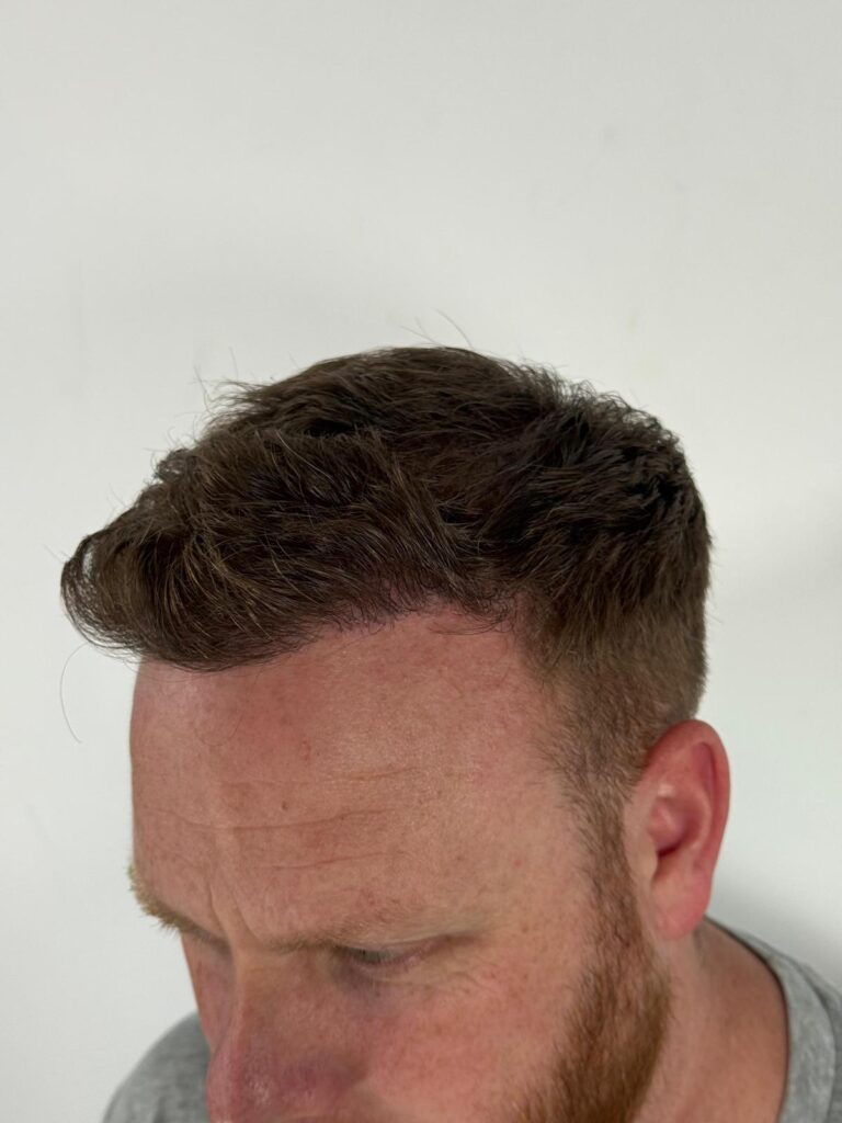 Natural-looking side profile result after a corrective hair transplant showing restored temple density