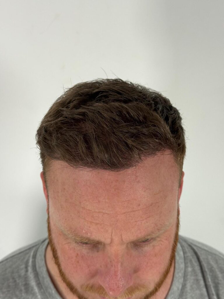 High-density hair restoration result from a top-down angle, showing seamless integration with existing hair