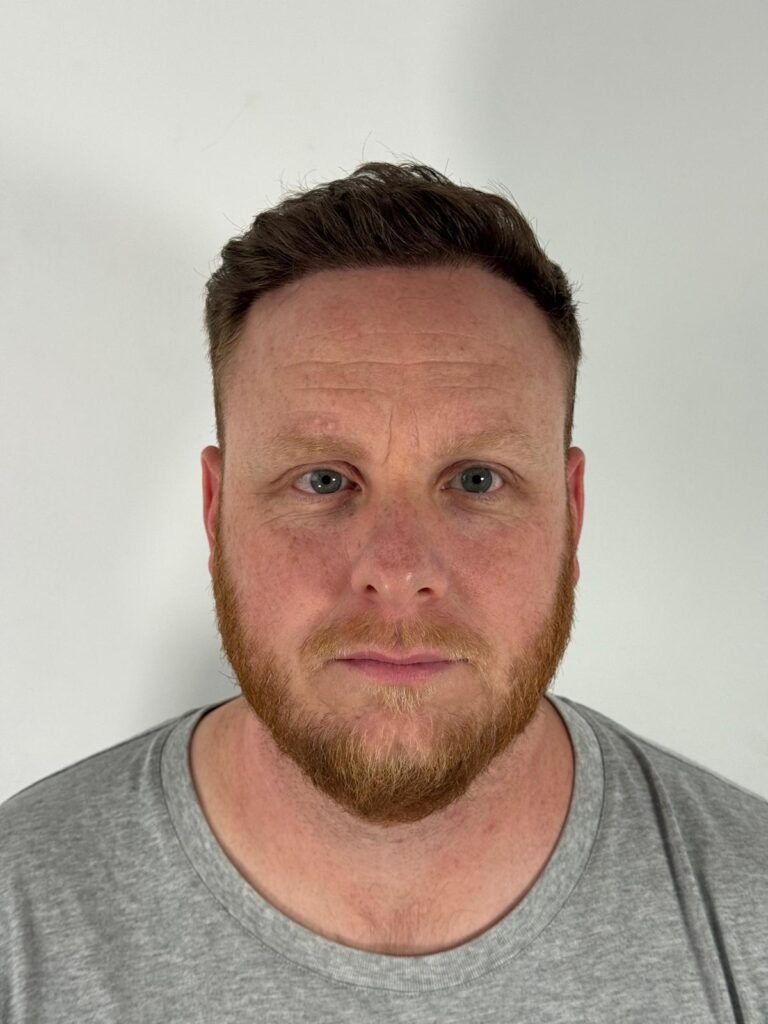 Successful hair transplant result for a male patient showing a full, natural hairline and improved facial harmony