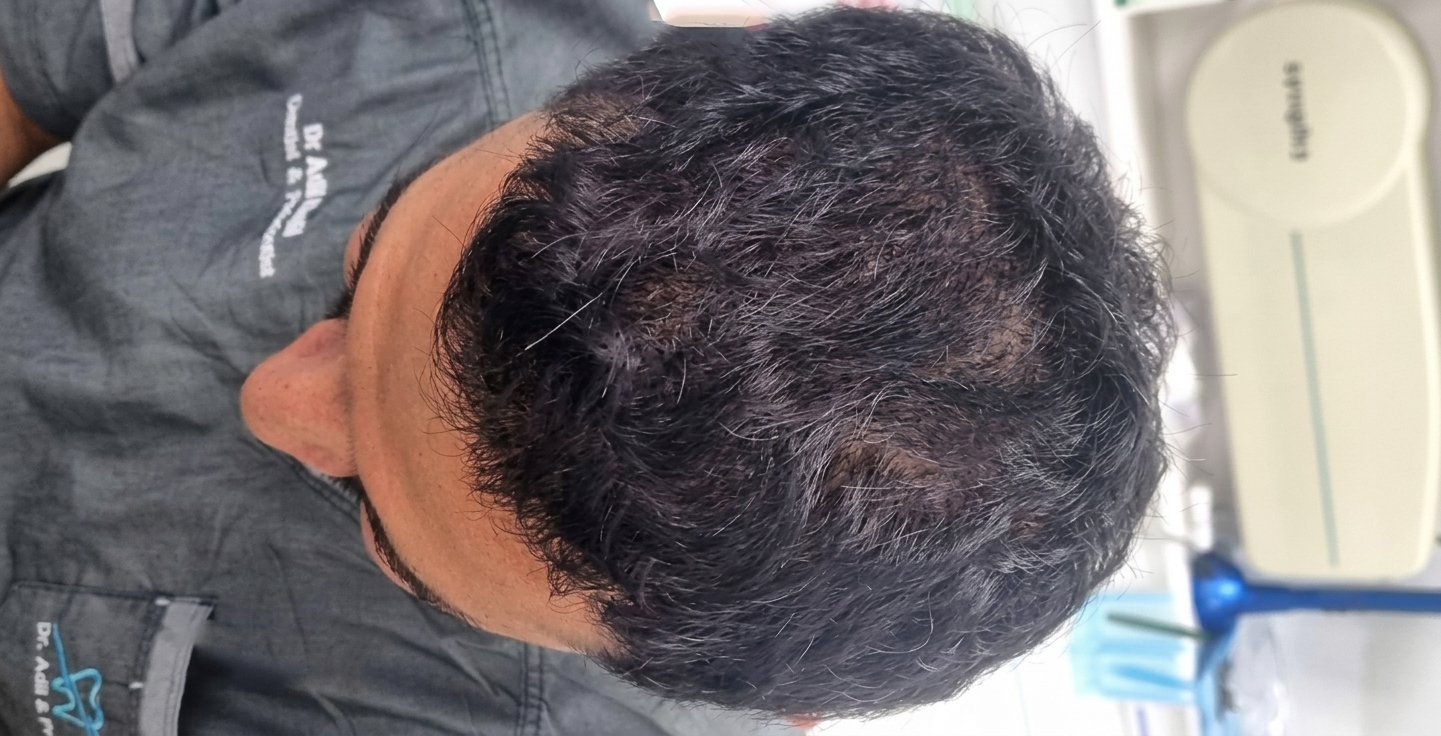 Post-hair transplant result showing restored hair density and full crown coverage at Vale Health Clinic