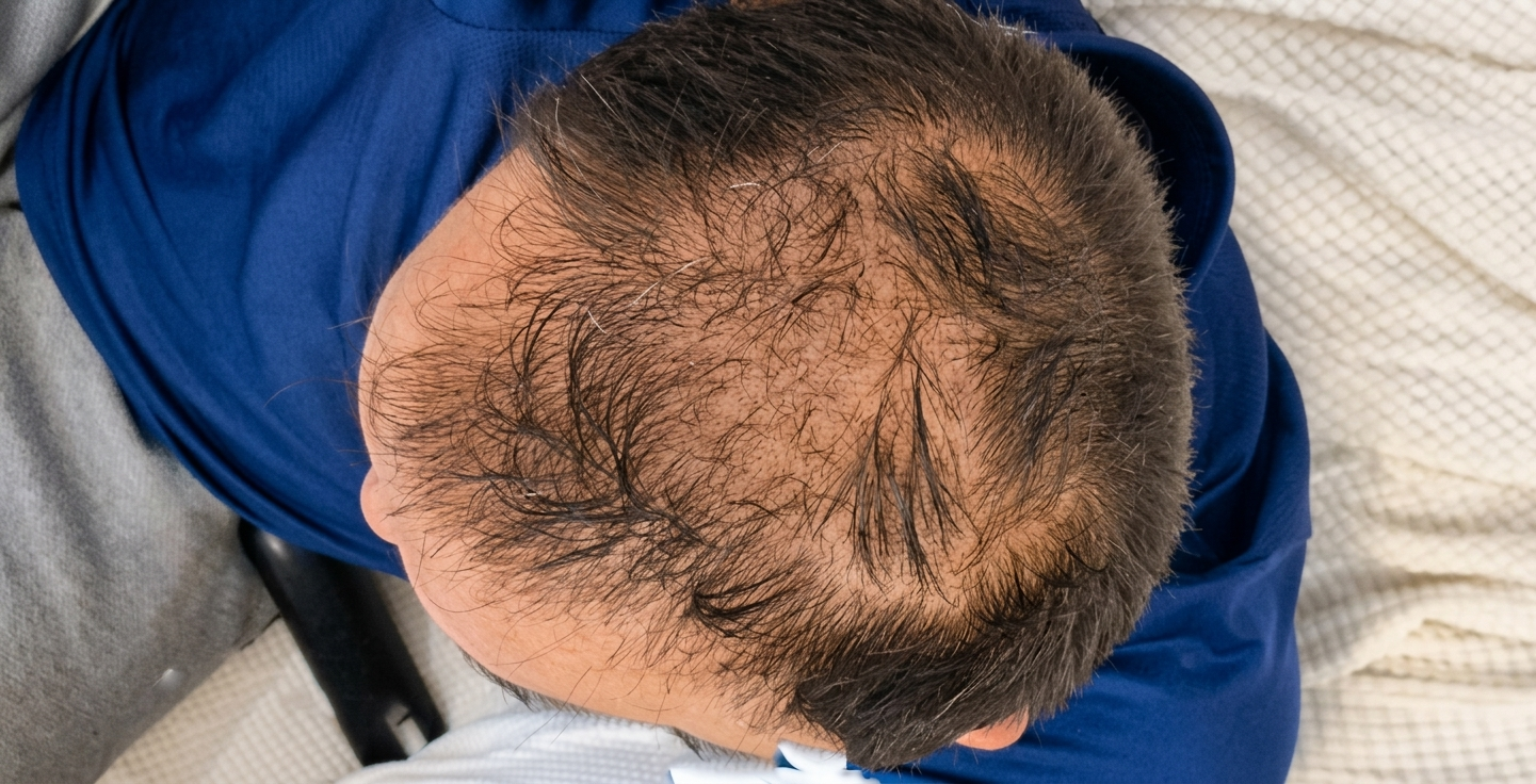 male-pattern-hair-loss-before-top-view Top-down view of male crown showing thinning hair before hair transplant at Vale Health Clinic